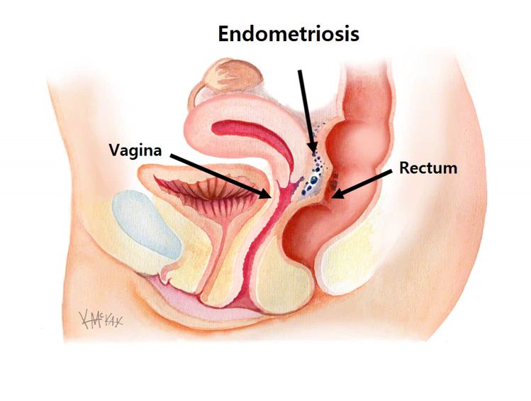 एन्डोमेट्रीओसिस (Endometriosis)