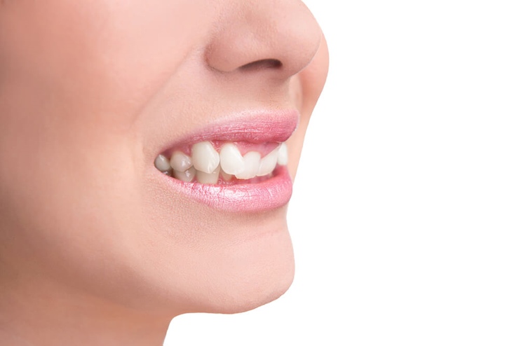 दांतों की समस्या जिन्हें बिना ब्रसेस के ठीक किया जा सकता है