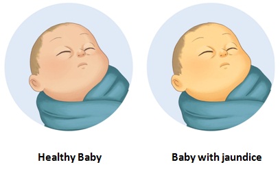 Jaundice in newborn